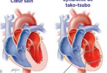 Photo of Le syndrome de Tako Tsubo (TTS),  ou « syndrome du cœur brisé »