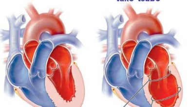 Photo of Le syndrome de Tako Tsubo (TTS),  ou « syndrome du cœur brisé »